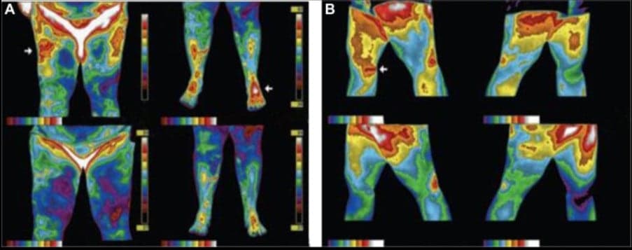Erdung Studie Arthritis