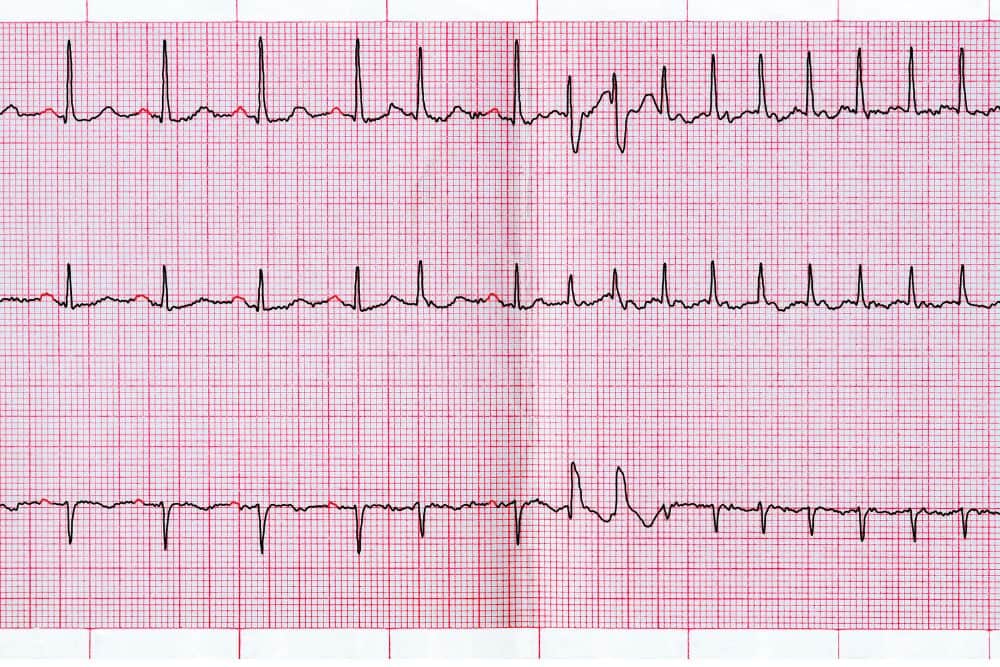 Vorhofflimmern EKG