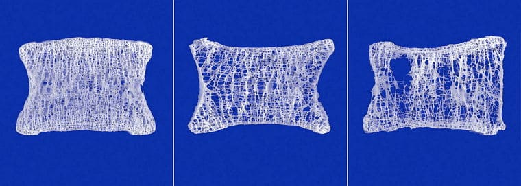 Starke Knochen Osteoporose