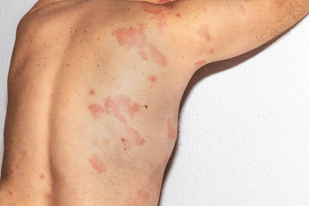 Histaminintoleranz Symptoome
